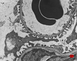 M,13y. | thin basement membrane syndrome